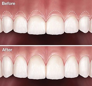 Toothwise Dental Clinic Crown Lengthening