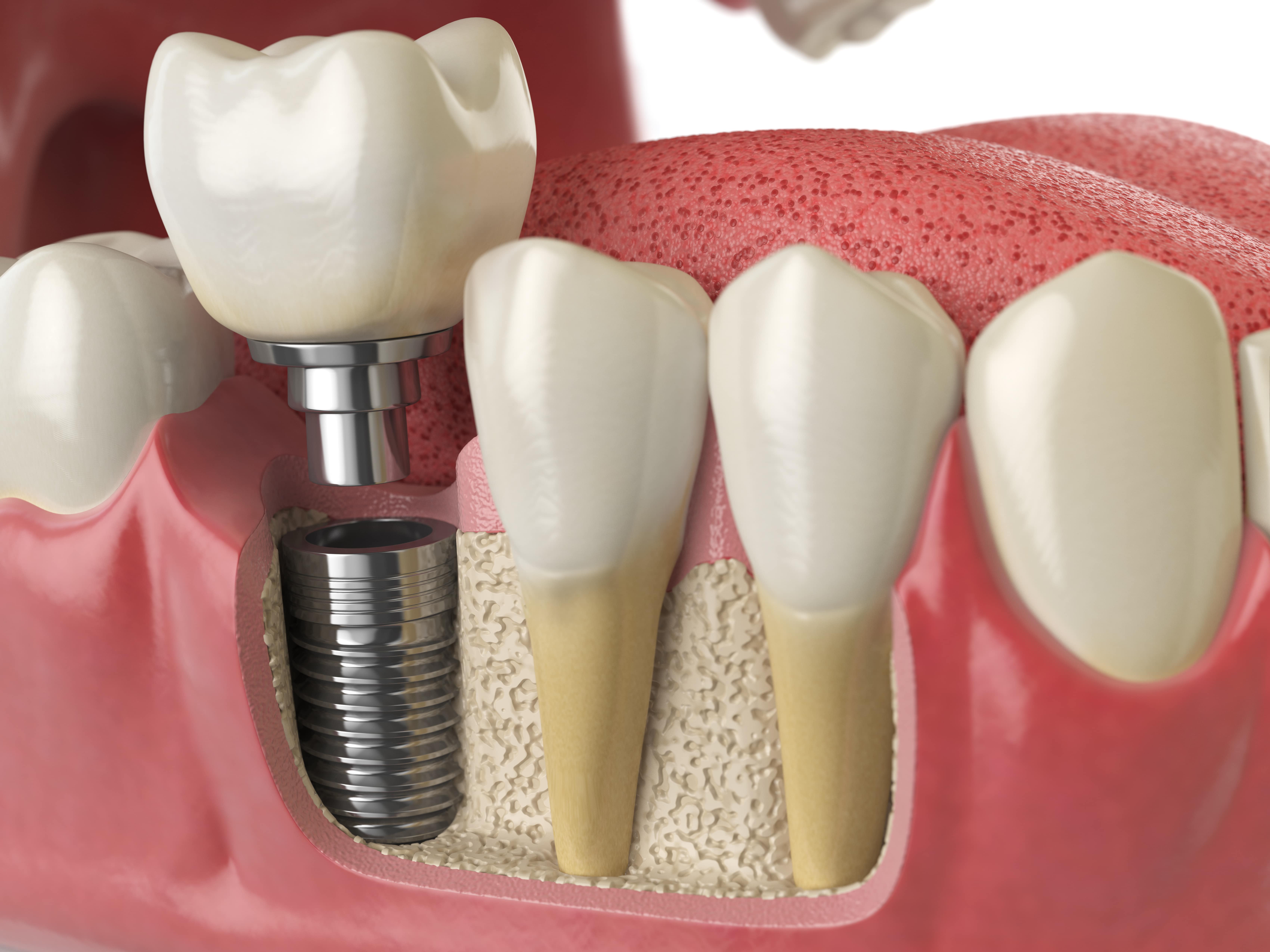 Toothwise Dental Clinic Dental Implants