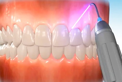 Toothwise Dental Clinic Gum Depigmentation