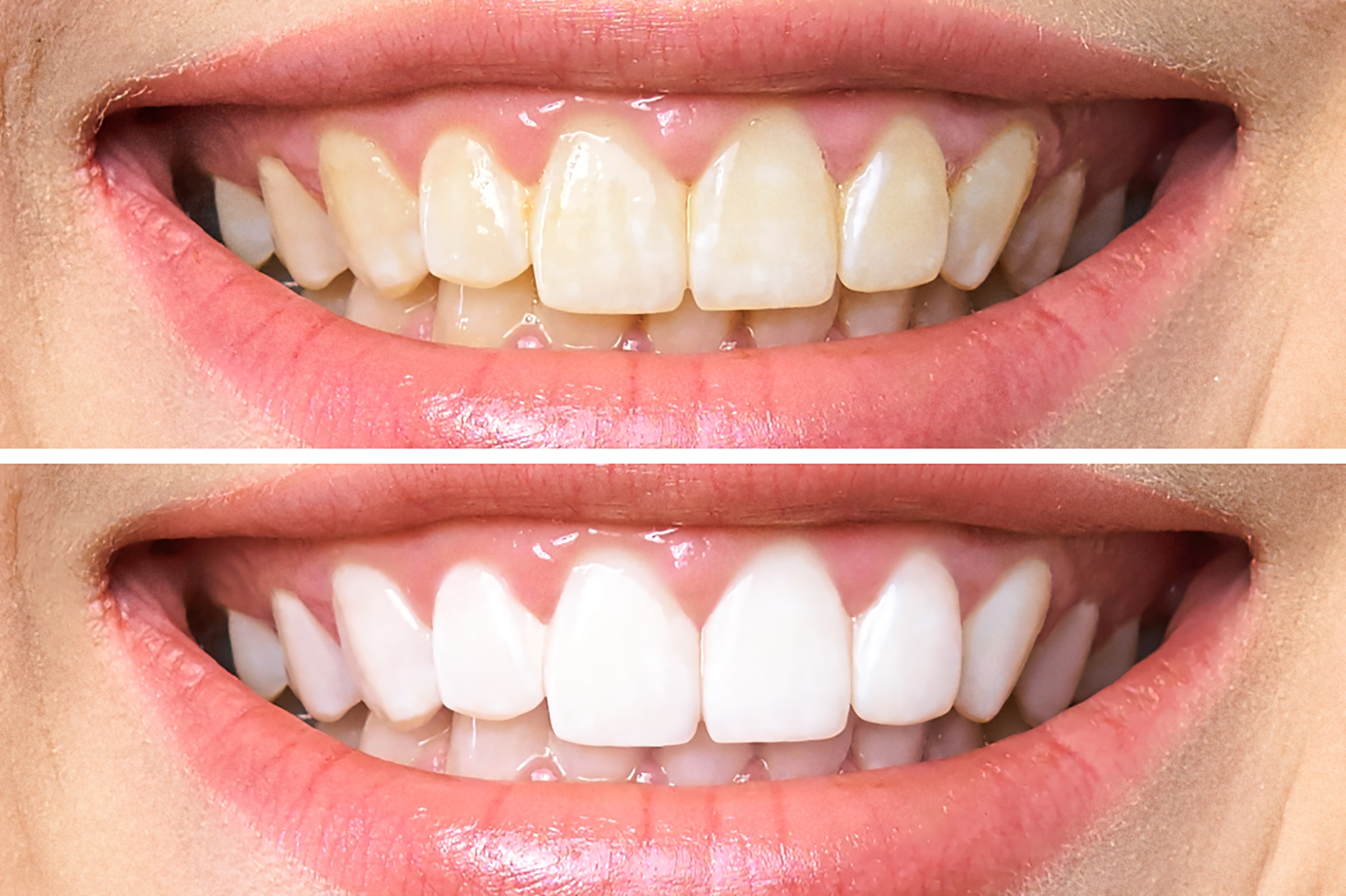 Toothwise Dental Clinic Teeth Whitening, Bleaching