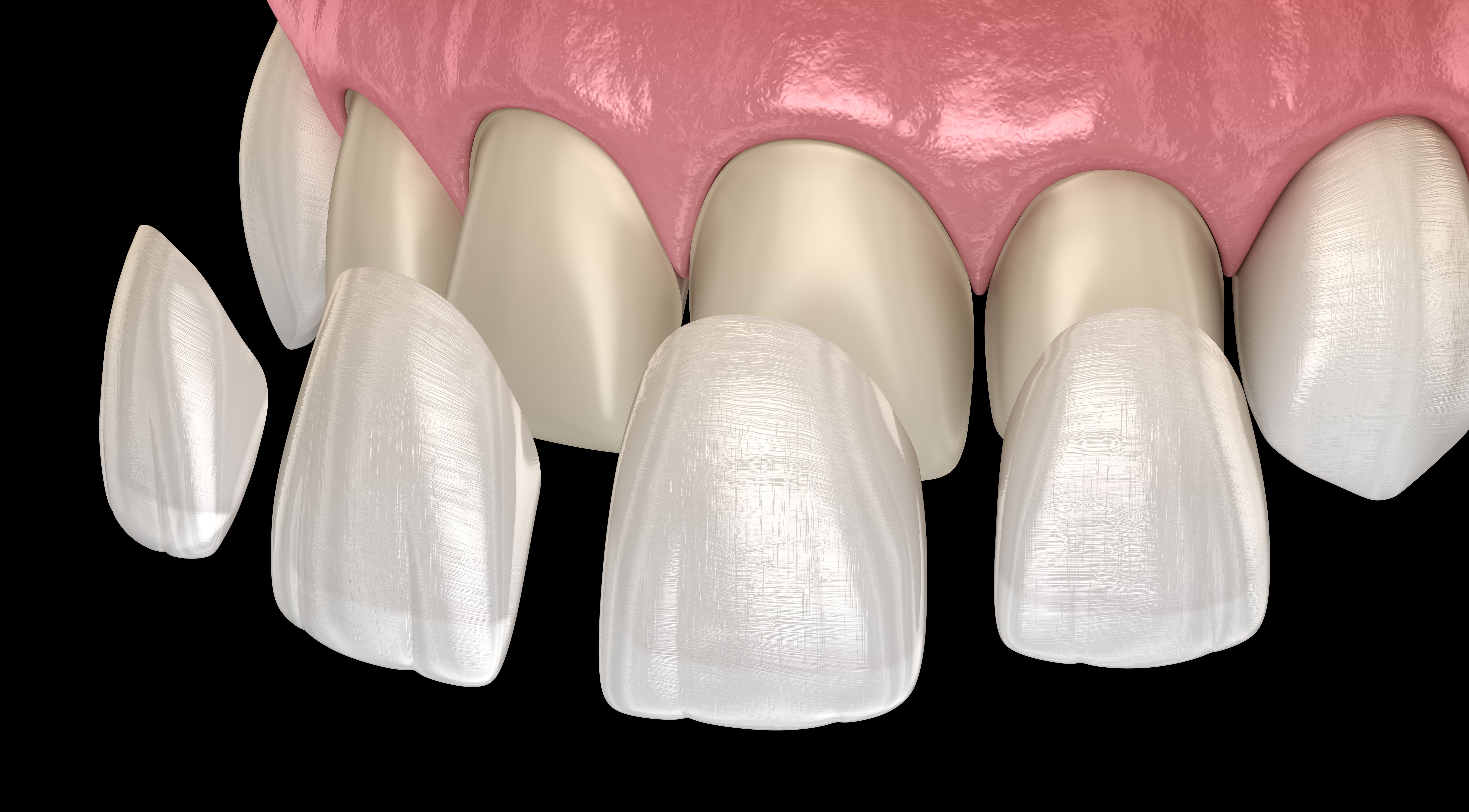 Toothwise Dental Clinic Veeners & Laminates